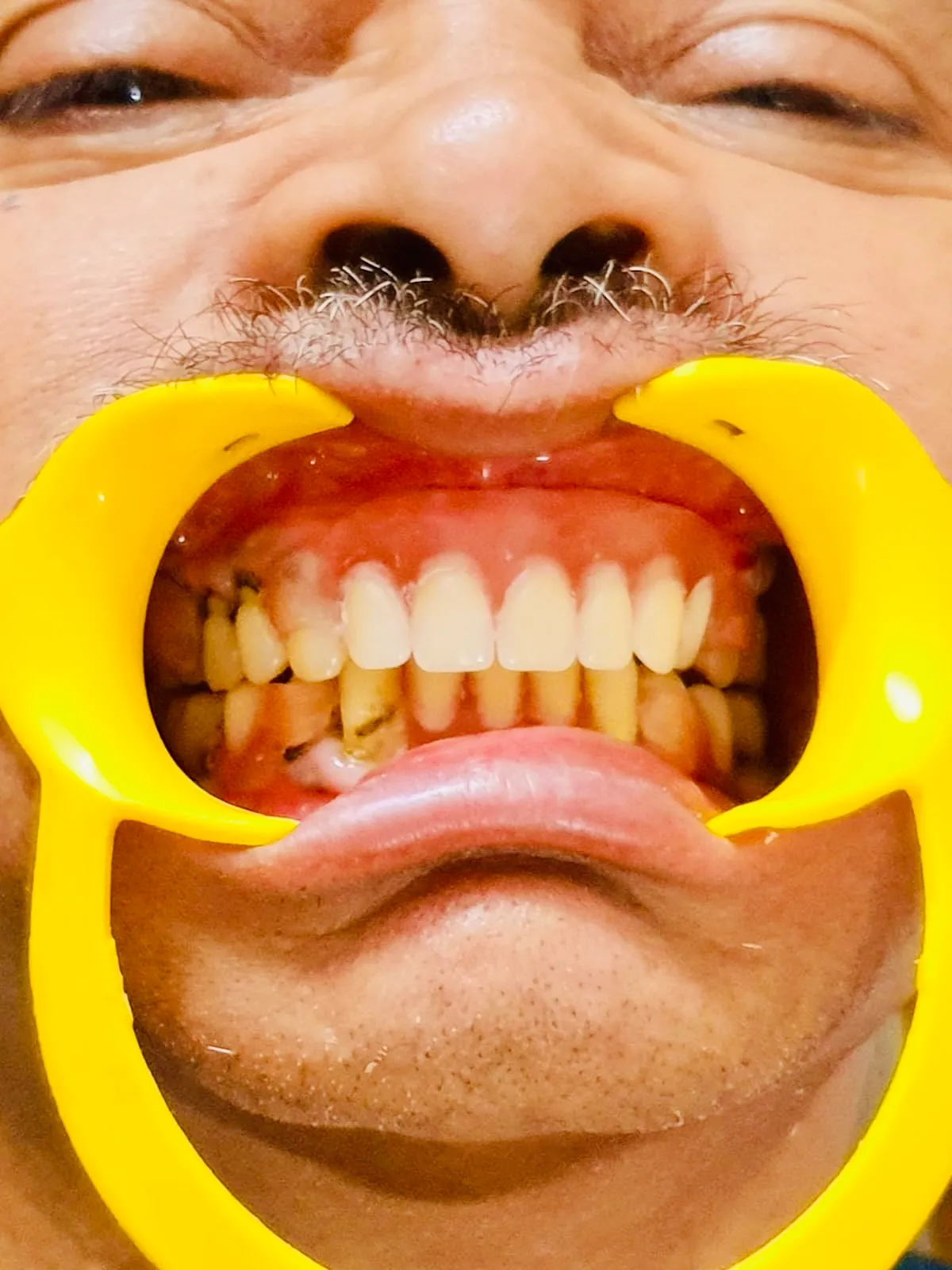 After Dental Treatment