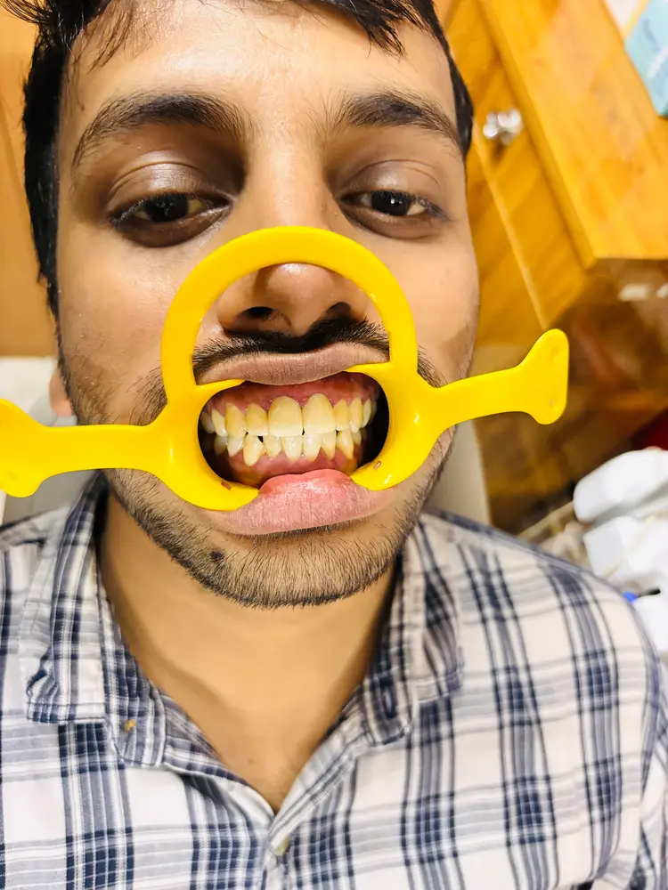 After Dental Treatment