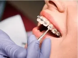 Braces treatment icon at Riya Smile Care Centre Uttam Nagar Delhi