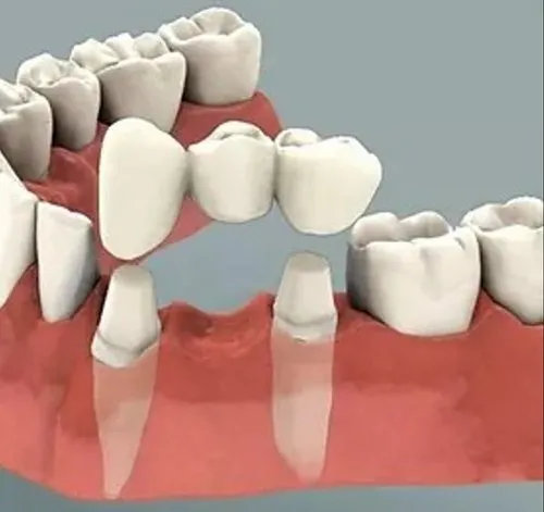 Crown & Bridges icon at Riya Smile Care Centre Uttam Nagar Delhi