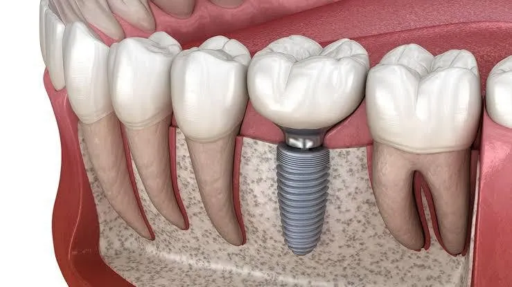 Dental implants treatment icon at Riya Smile Care Centre Uttam Nagar Delhi