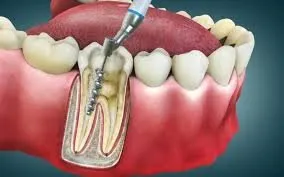 Root Canal treatment icon at Riya Smile Care Centre Uttam Nagar Delhi