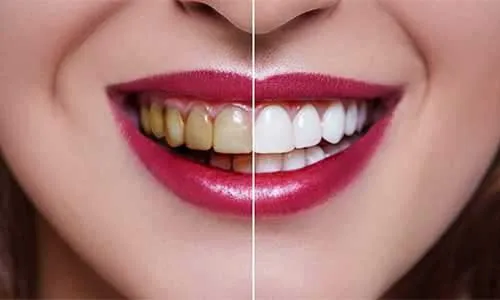 Teeth Whitening icon at Riya Smile Care Centre Uttam Nagar Delhi