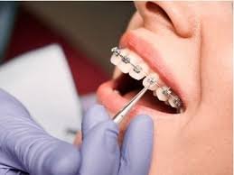 Braces