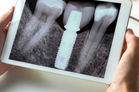 Digital X-ray (RVG)