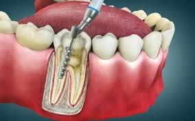 Root Canal Treatment (RCT)