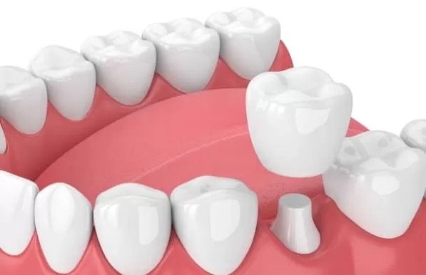 Zirconia Cap